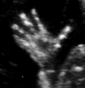 Ultrasound image of a hand.