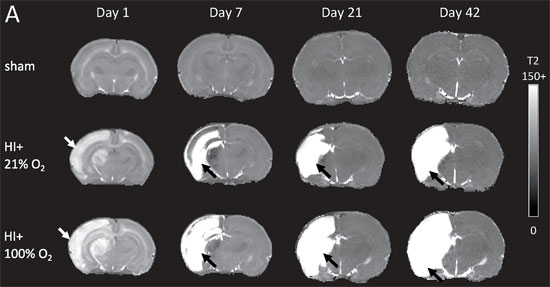 MR bilde av hypoksisk-iskemisk hjerneskade