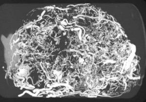Micro CT-image of the blood vessels in a breast tumor grown in a mouse
