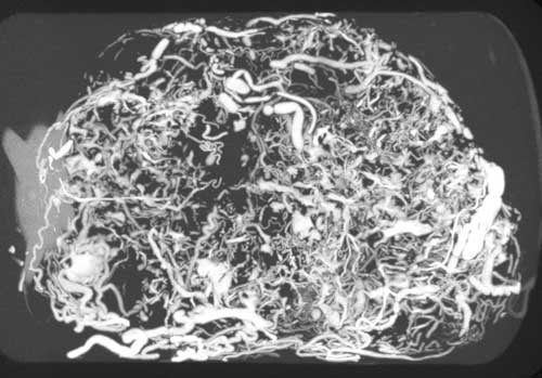 vessels blood tumor breast Indiana scanner