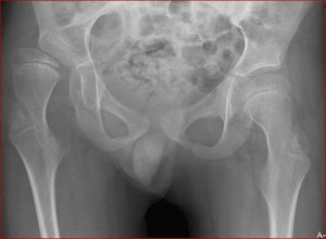 X-ray of hips of patient with cerebral palsy.