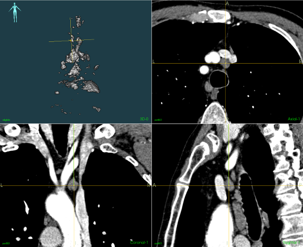 CT images identifying lymph nodes.