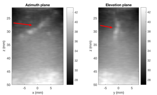 2D projections of 3D coronary ultrasound images using a standard high cut-off filter.