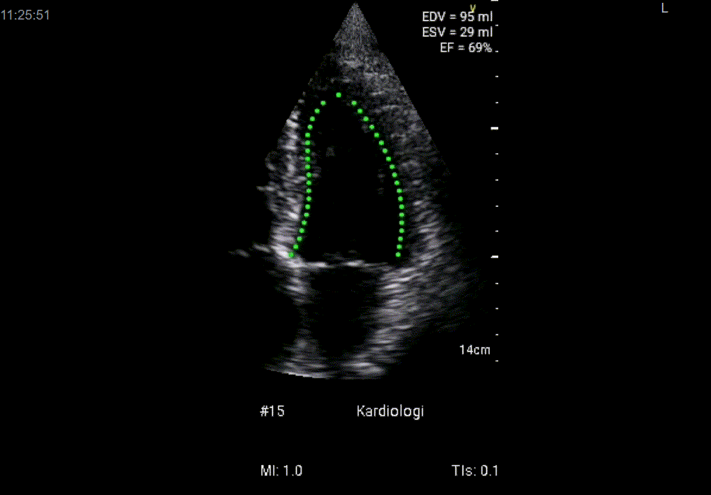 Animated gif of cardiac ultrasound.