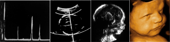 Ultrasound photos of a baby in 1960, 1970, 1990 and 2000.