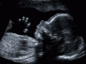 Ultrasound is offered to all pregnant women in week 18 of the pregnancy.