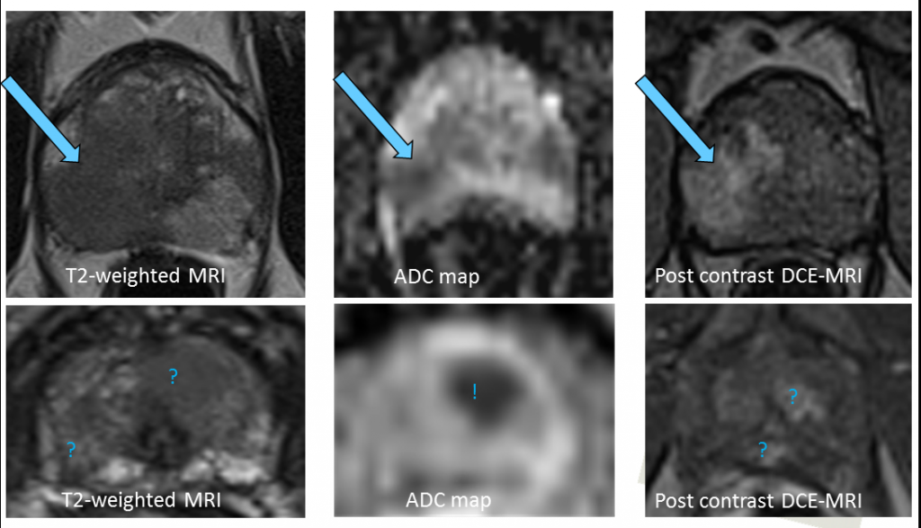 MR-bilder av prostatakreft
