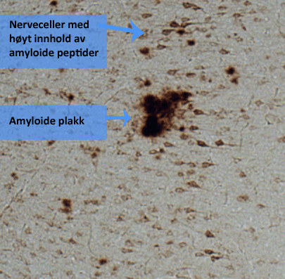     Hjernebark angrepet av amyloide peptider- og proteinavleiringer (begge farget brunt).