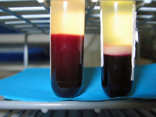 The test tube to the left contains a blood sample from a healthy person. The test tube to the right contains a blood sample form a child with leukaemia. “Leukaemia” means “white blood”, and one can clearly see why when looking at the white layer of cells in the test tube to the right. (Photo: Bendik Lund)