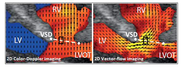 bildet viser forskjell mellom fargedooppler og vector-flow-avbildning
