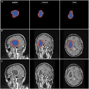 MRI images of glioma segmentation