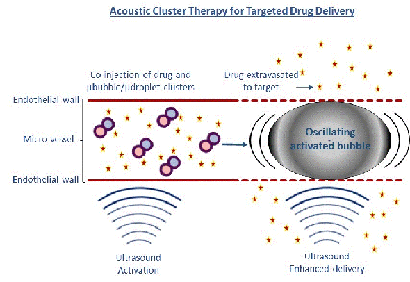 Illustration: Ultrasound applied to tumors after injecting clusters of microbubbles/microdroplets causes giant oscillating bubbles. 