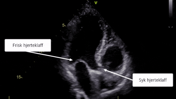 ultralydbilde av hjerte med trang hjerteklaff