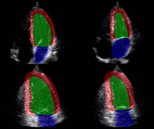 Ultrasound images of heart with automatic detection of heart wall.