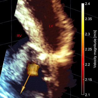 3D ultrasound image of aortic stenosis.